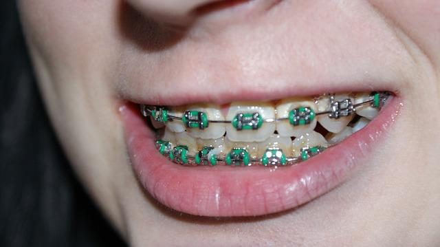 Learning To Live With Braces